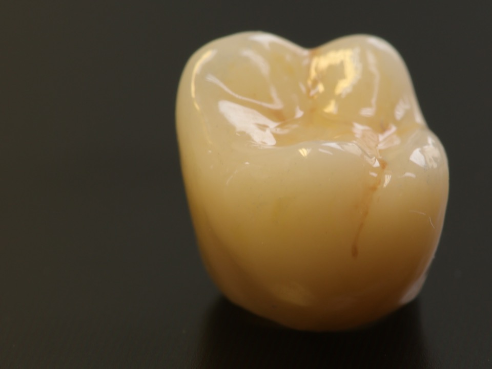 Vollkeramische Krone aus Zirkoniumdioxid